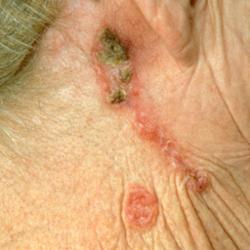 Example of skinCancer